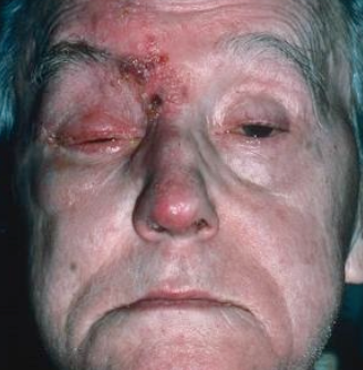 <p>What can Varicella-Zoster Shingles (VZV/HHV3) be associated with?</p>