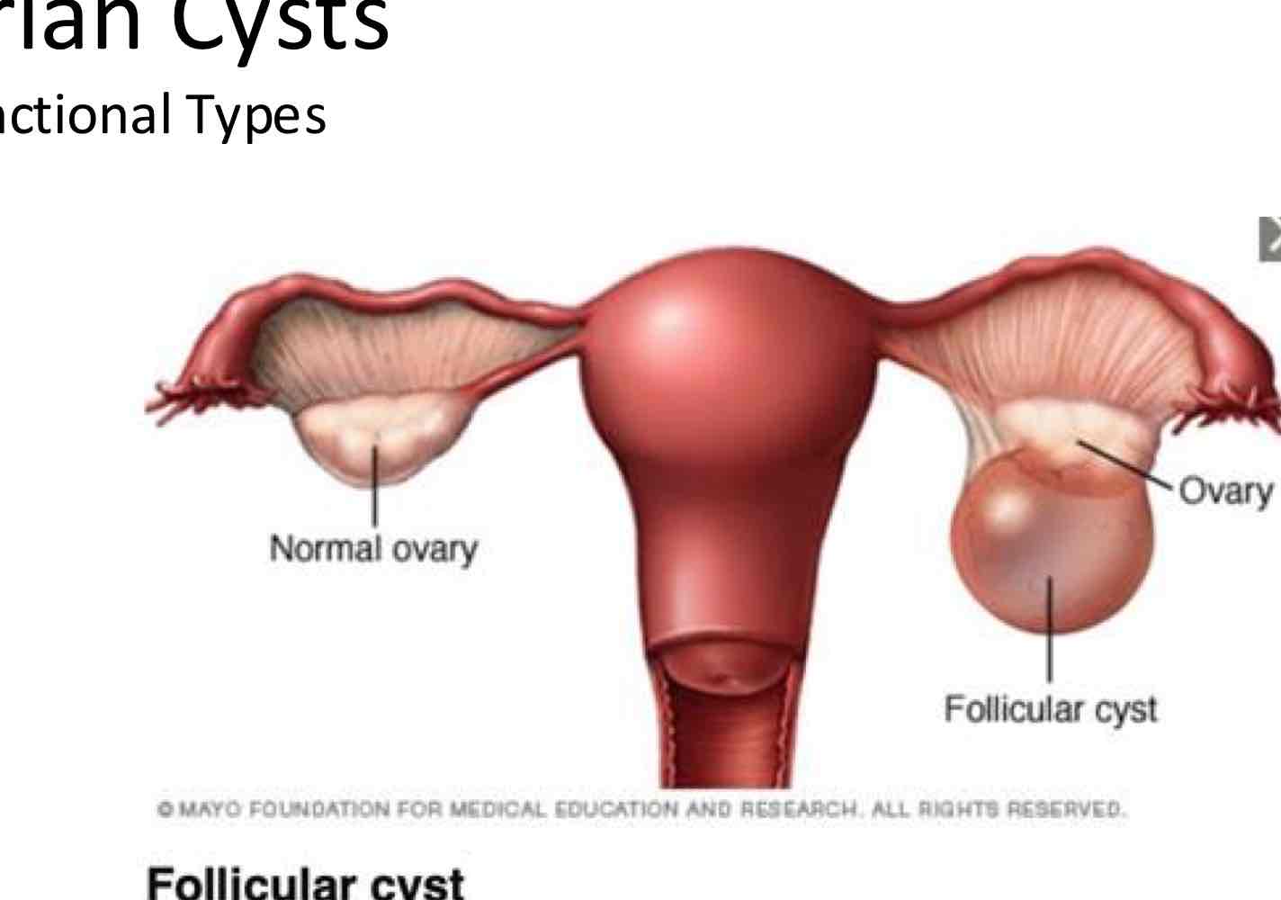 <ul><li><p>Occurs when the follicle of the ovary <strong>doesn’t rupture or release its egg.</strong></p><ul><li><p>Instead, it grows until it becomes a <strong>cyst</strong></p></li></ul></li></ul><p></p>