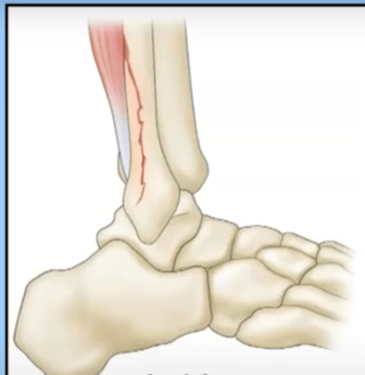 <p>a fracture in which a fragment of bone has been pulled away by a tendon and it's attachment</p>