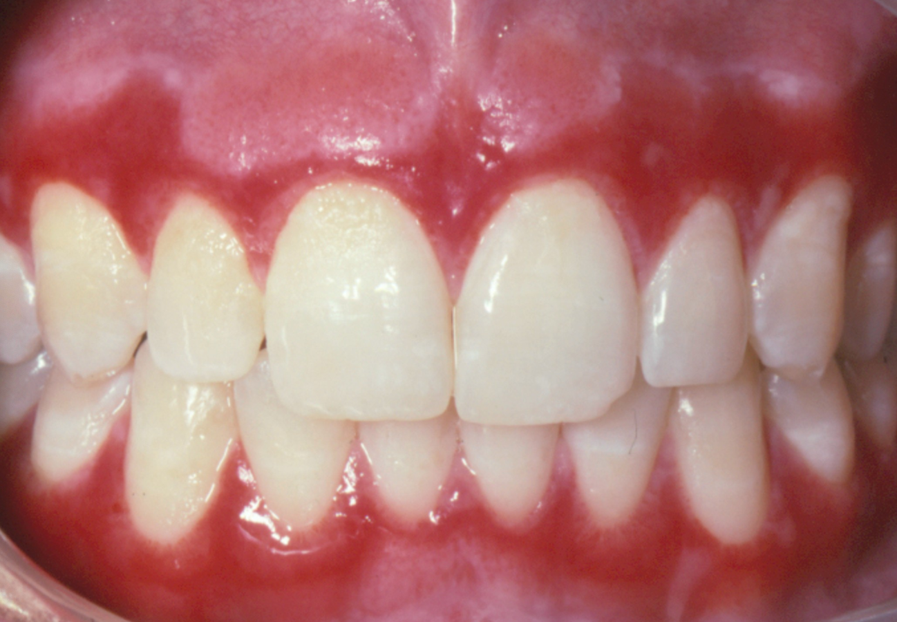 <p>3e. What is the most appropriate initial therapy?</p><p><span><span>Dexamethasone oral solution </span></span></p><p><span><span>Penicillin tablets</span></span></p><p><span><span>Mycelex troches</span></span></p><p><span><span>Acyclovir tablets</span></span></p>