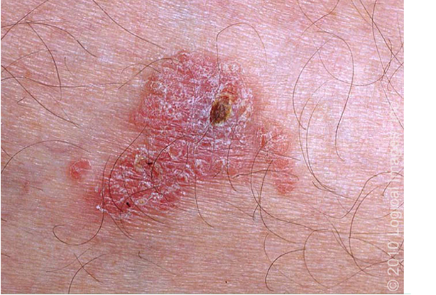 <ul><li><p>slow growing, erythematous, <strong>well demarcated scaly patch/plaque</strong></p></li><li><p>typically asx- pain/tenderness suggest invasive</p></li><li><p>Erythroplasia of Queyrat- red plaque on on glans penis or labia minora; may be assoc. w/ bleeding, pruritus, pain</p></li></ul><p></p>