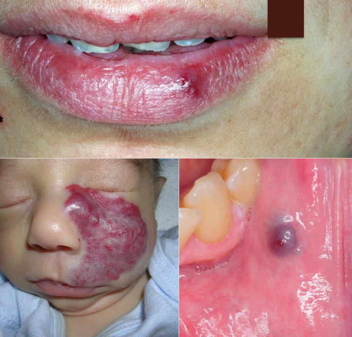 <p>How would you manage hemangioma?</p>