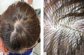 <p>an abnormal loss of hair during the first stage (anagen) of the hairs growth cycle.</p>