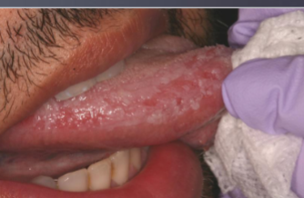 <p>biting trauma on lateral border of tongue </p>