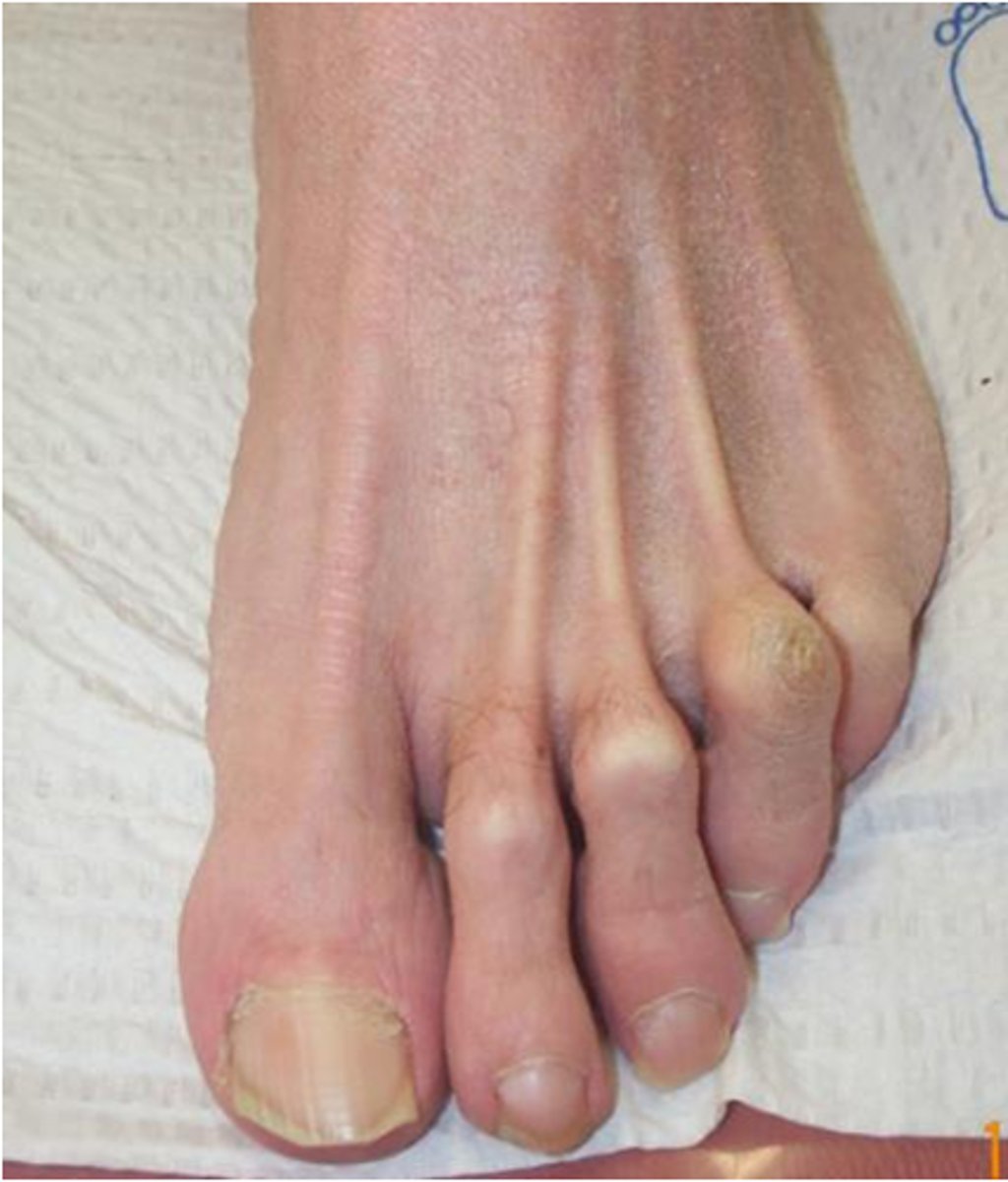 <p>the proximal interphalangeal (PIP) joint is flexed, the metatarsophalangeal (MTP) joint is extended, and the distal interphalangeal (DIP) joint is also extended</p>