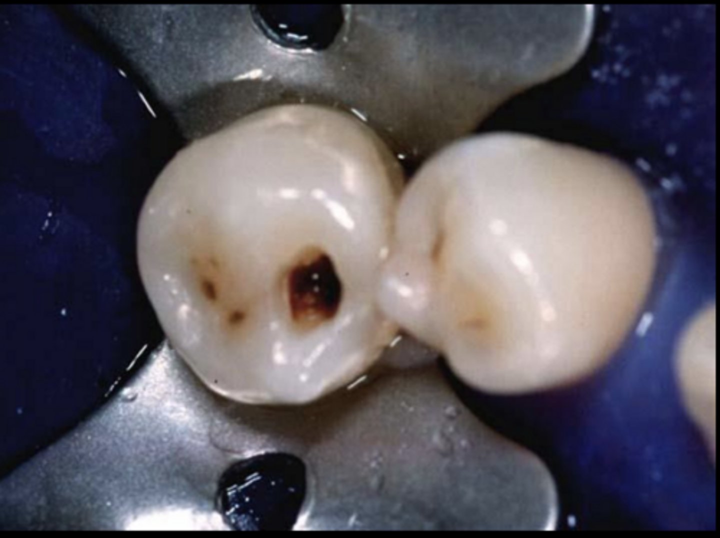 <p>If lesion is NOT sufficiently cavitated, removal of enamel is necessary (High speed, with water)</p>