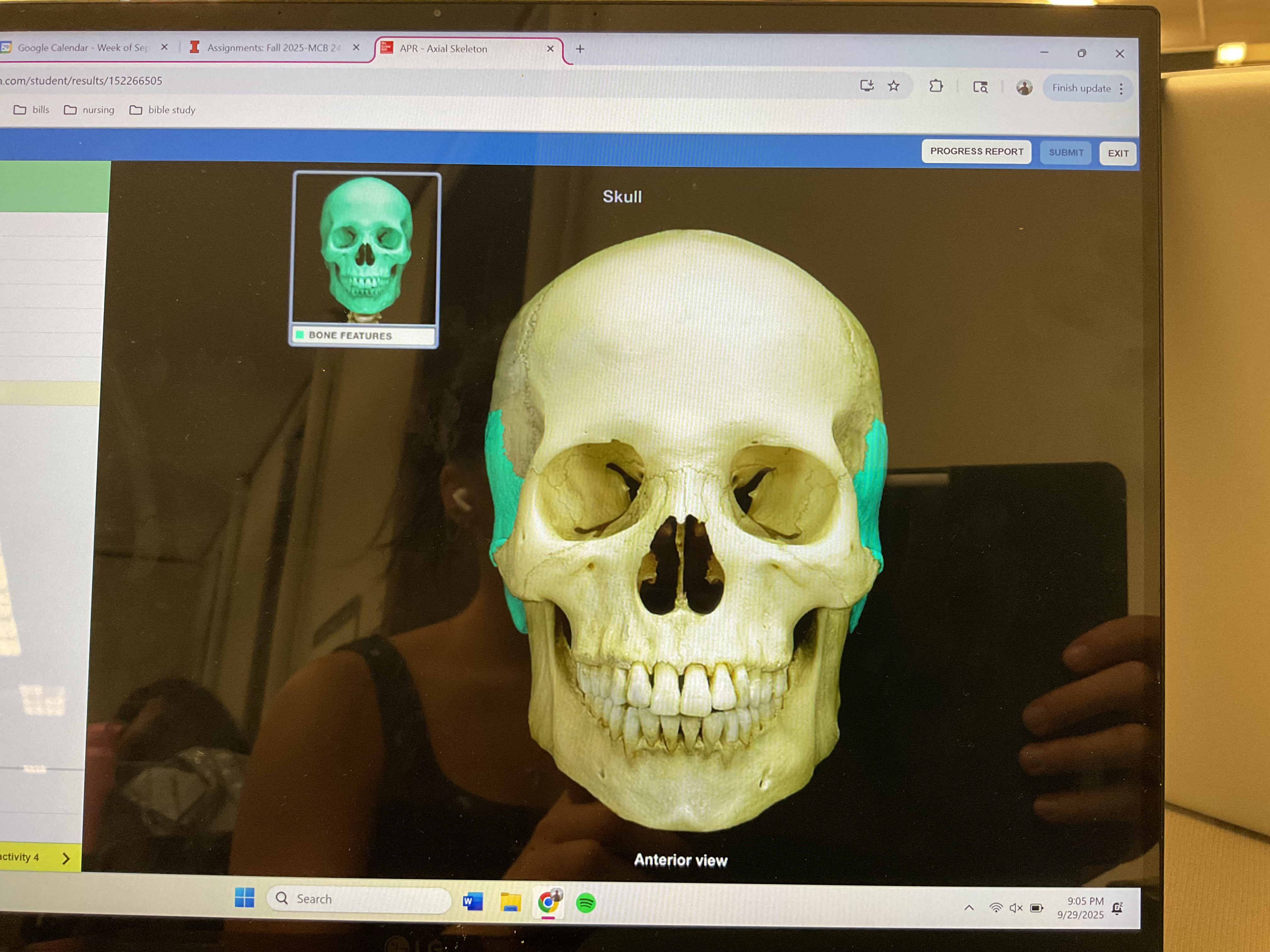 <p>Temporal bone </p>
