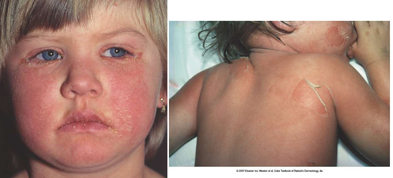 <p>welke aandoening wordt hier afgebeeld? </p>