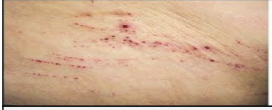 <p>\n Superficial injury with a sharp object that creates a linear scratch on the skin.</p>