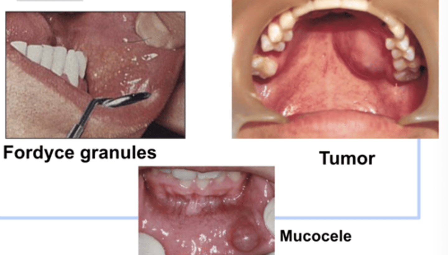 <p>possible site of pathology; variations of normal</p><p>fordyce granules, tumor, mucocele</p>