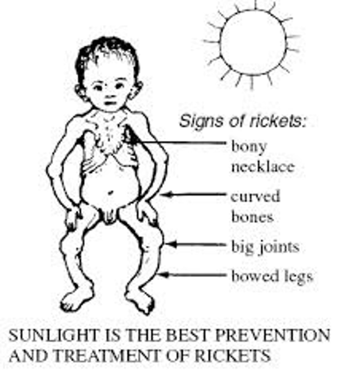 <p>Cause: vitamin D deficiency</p><p>Symptoms: Bone pain, bone loss, muscle weakness</p>