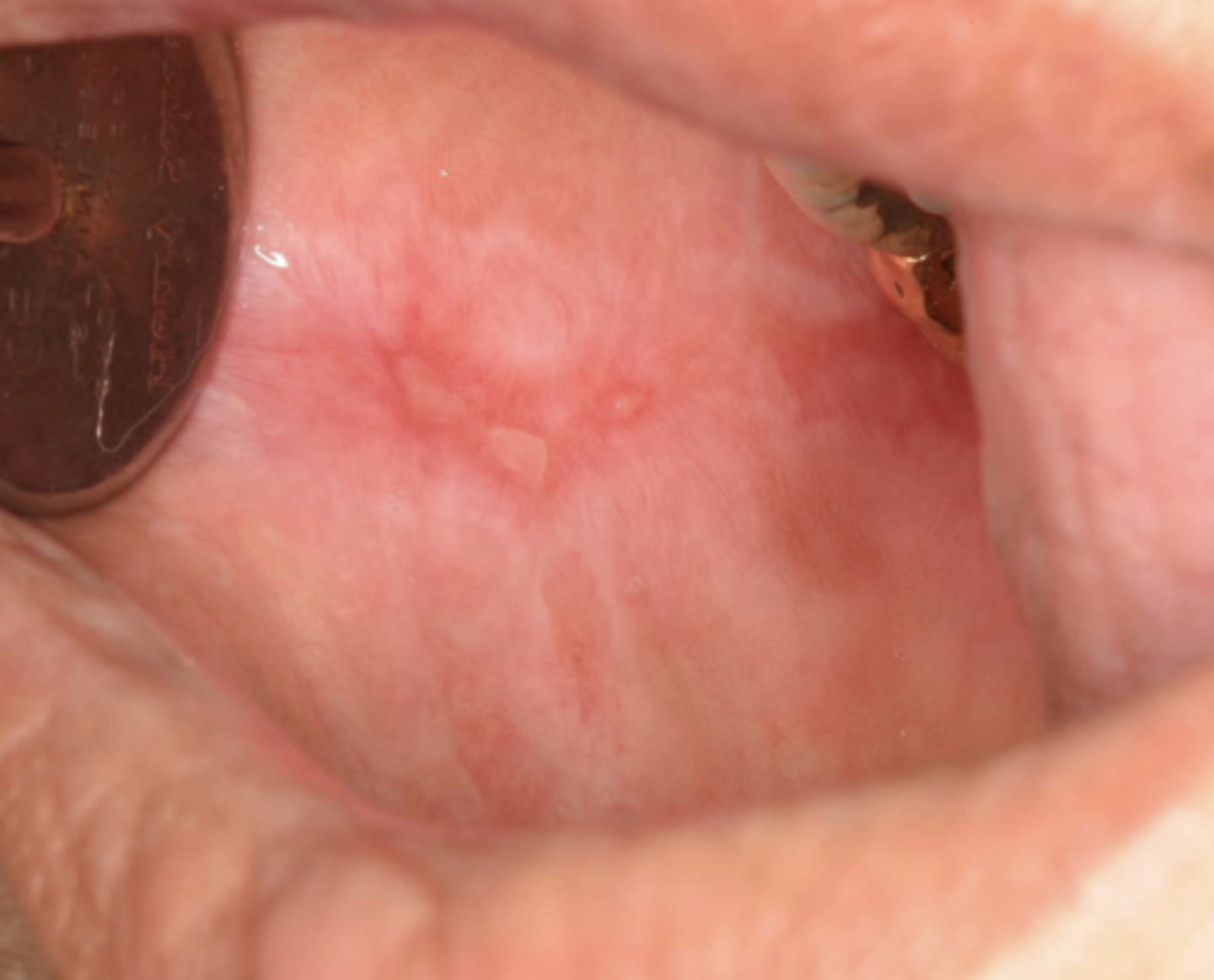 <p>Patient also presents with a <strong>butterfly malar rash</strong>. What condition do you suspect?</p>