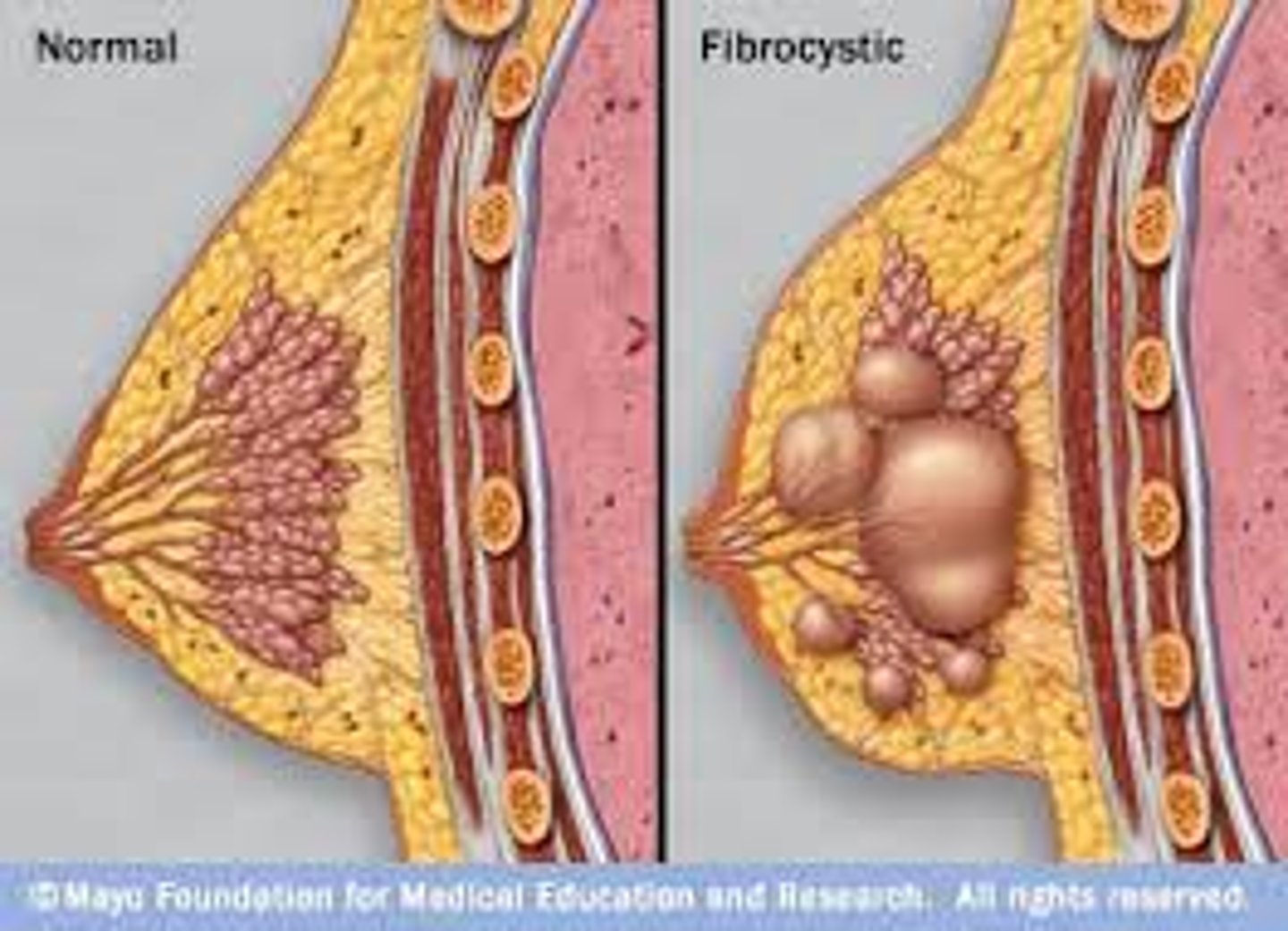 <p>thick/lumpy areas in the breast<br>fluctuate with menstrual cycle<br>may be tender or painful to patient<br>non- proliferative lesions</p>
