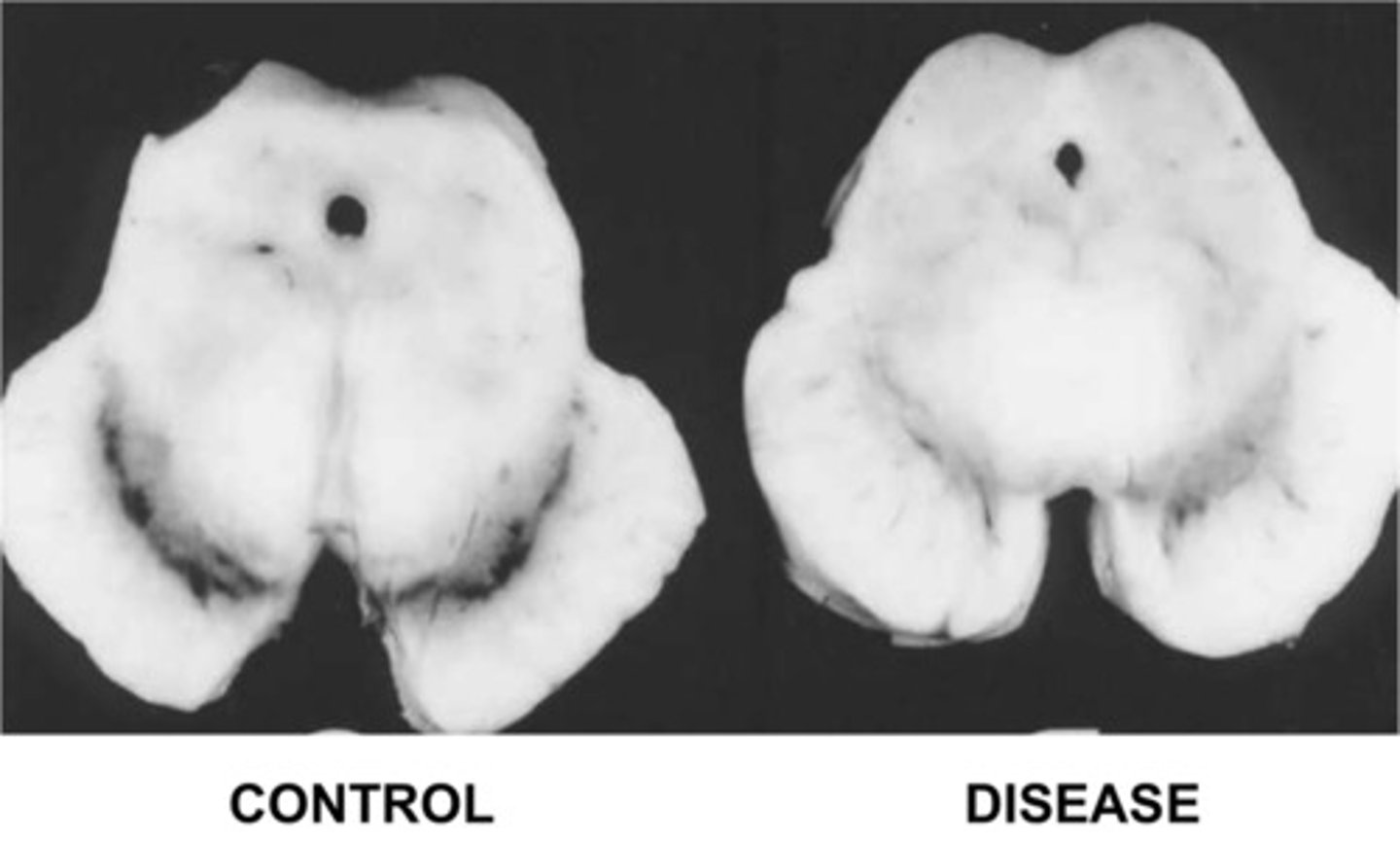<p>Progressive disorder caused by dopamine deficiency due to neurodegeneration in the substantia nigra</p>