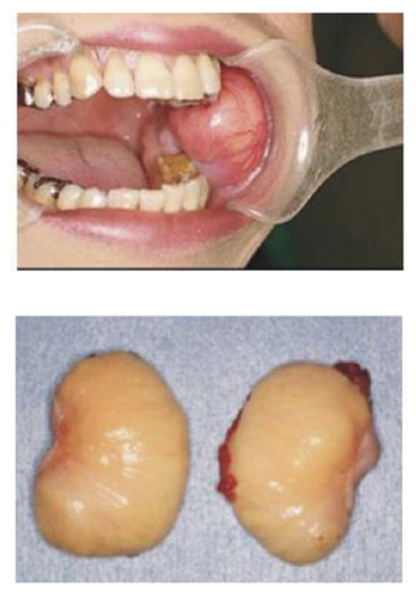 <p>a benign, slow-growing fatty tumor located between the skin and the muscle layer</p>