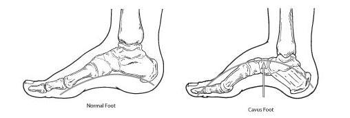 High arch, curled toes, compact wave, narrow 