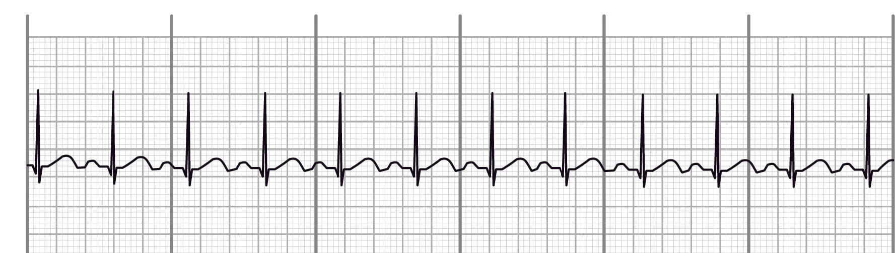 <p>sinus tachycardia</p>