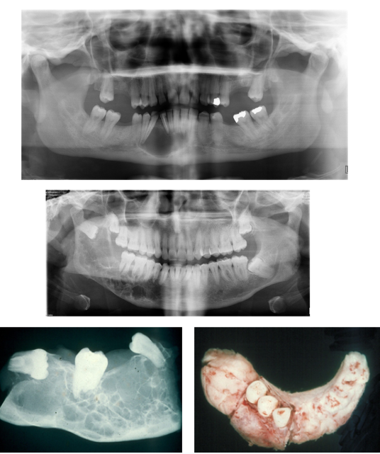 <p>Uni or Multi-Locular Radiolucency</p><p>- Soap Bubble Appearance</p><p>- Root Displacement or Resorption</p>