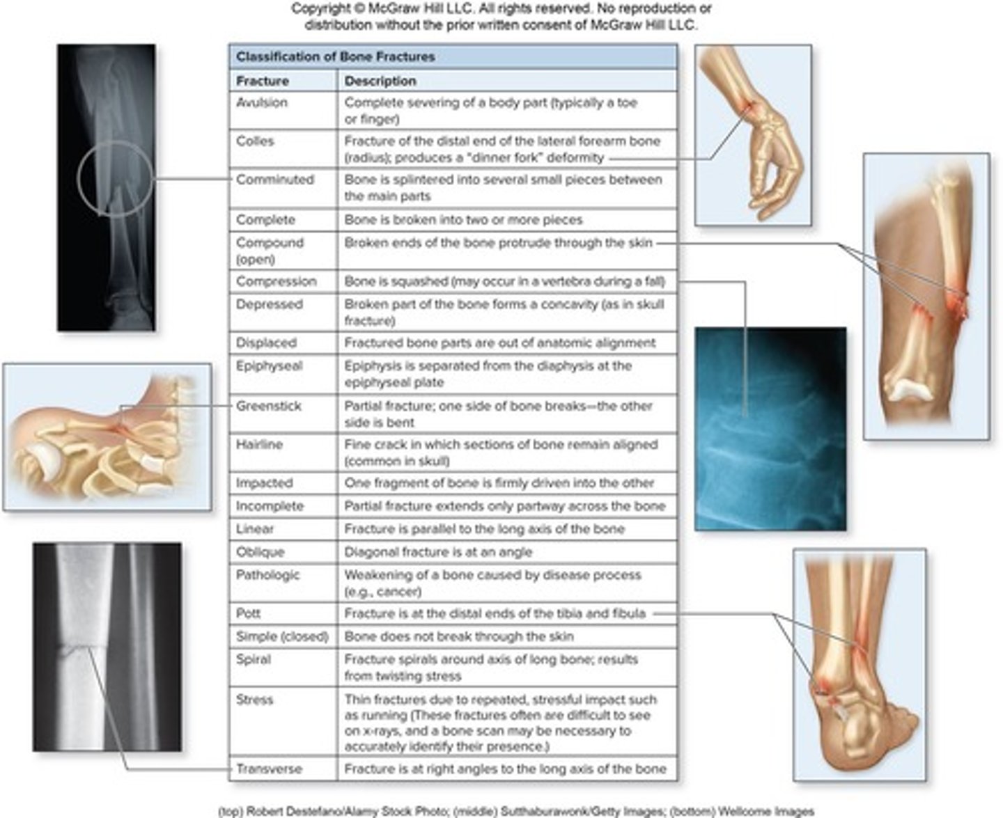 <p>Fractures can be classified as stress, traumatic, or pathologic.</p>