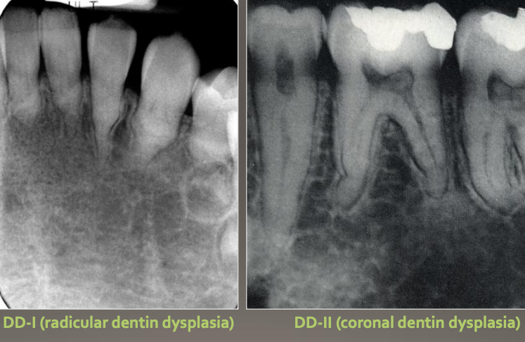 <p>A hereditary condition affecting dentin</p><ul><li><p>Autosomal dominant</p></li><li><p>Both dentition affected</p></li><li><p>2 types</p><ul><li><p>DD1- radicular</p></li><li><p>DD2- coronal  </p></li></ul></li></ul><p></p>