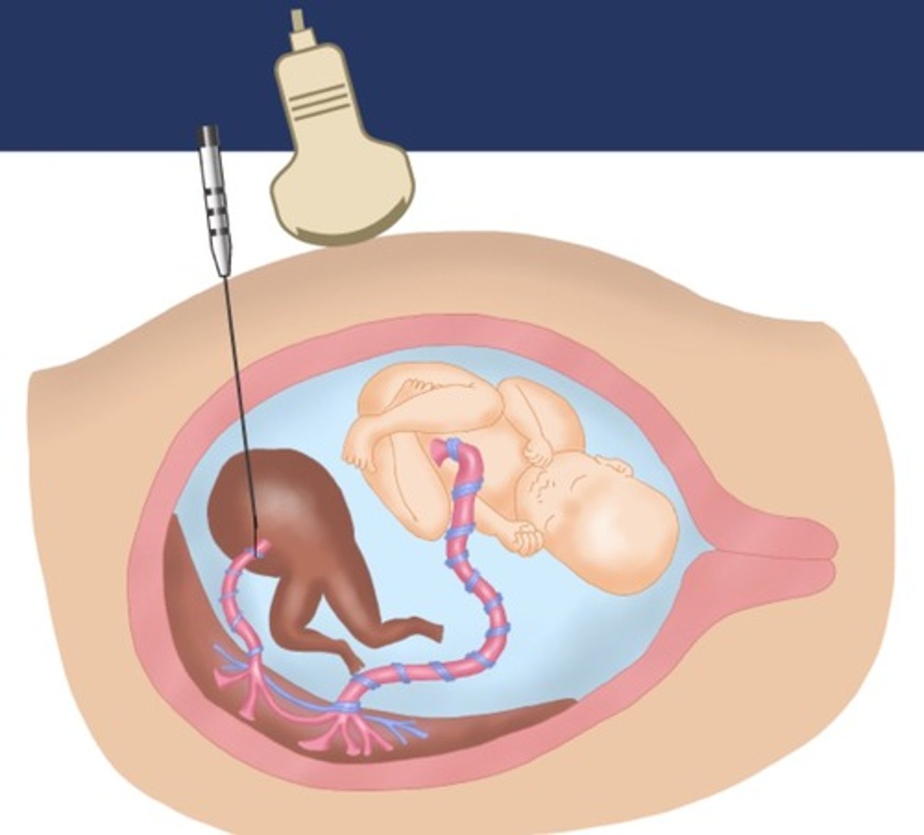 <p>95% survival of normal twin</p>