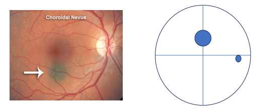 <p>Defects in the choroid and outer retina will cause a <strong>field defect</strong> that is<strong> similar in shape to the lesion</strong> and<strong> located in the corresponding location</strong> of the field (e.g., a <strong>lesion </strong>in the <strong>superior nasal </strong>retina should be <strong>found </strong>in the <strong>inferior temporal </strong>field)</p>