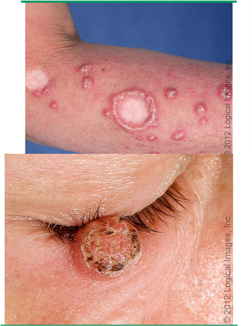 <ul><li><p>sharply demarcated, firm, erythematous or skin colored dome shaped nodule w/ central keratotic plug</p><ul><li><p>removal of keratotic core leaves a crater</p></li></ul></li><li><p>w/in few weeks , can grow to 1-2 cm</p></li><li><p>spontaneous regression occurs w/in 2-6 mos in most cases</p></li><li><p>location- sun exposed sites (esp. w/ hair)</p></li></ul><p></p>