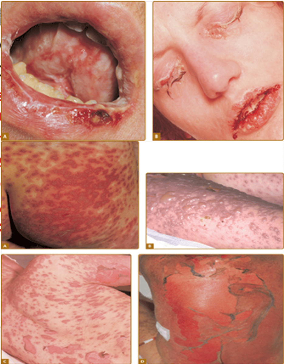 <p>skin detachment of &lt;10% of body </p><p><strong>type IVc</strong></p><p>-commonly cauased by meds </p>