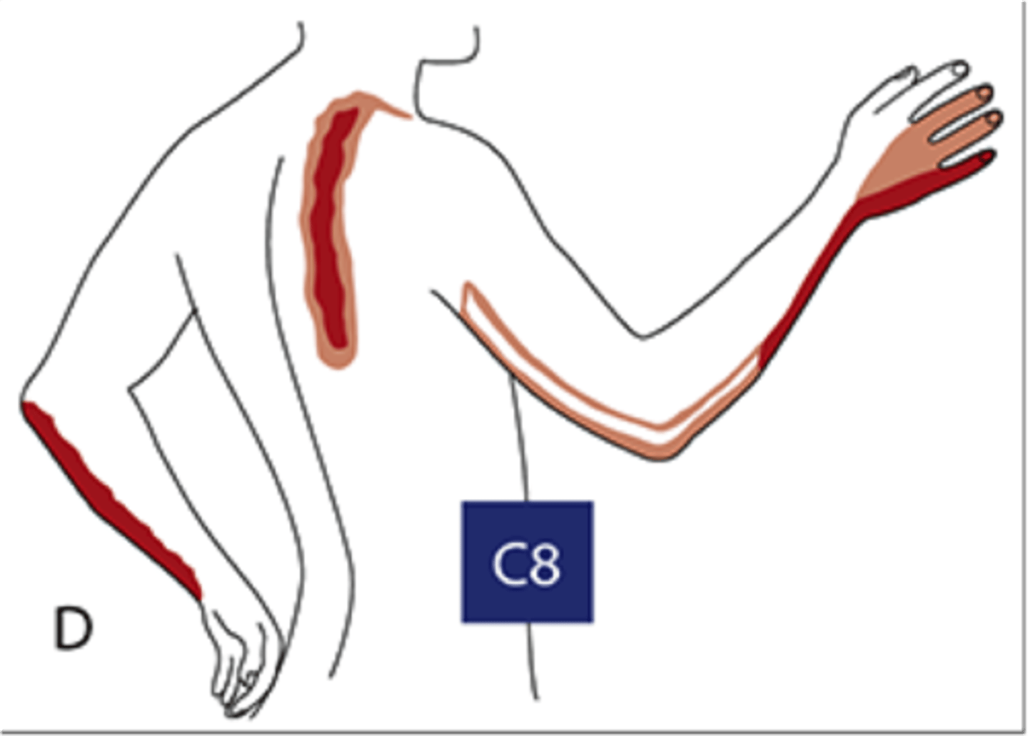 <p>Neck pain, paresthesia to ring &amp; little fingers, weakness in C8-innervated muscles (finger flexors)</p>