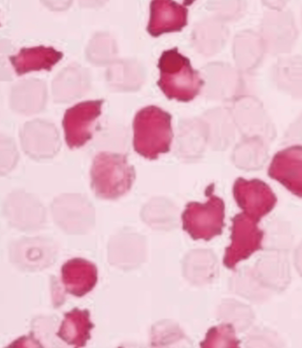 <p>Based on the principle that HbF is the major hemoglobin in babies and A1 is the most common in adults. HbF is resistant to acid while HbA1 is NOT. When acid is added, adult red cells will appear as ghost cells while baby RBCs will remain intact. The slide is then stained and baby red cells will be red.</p>