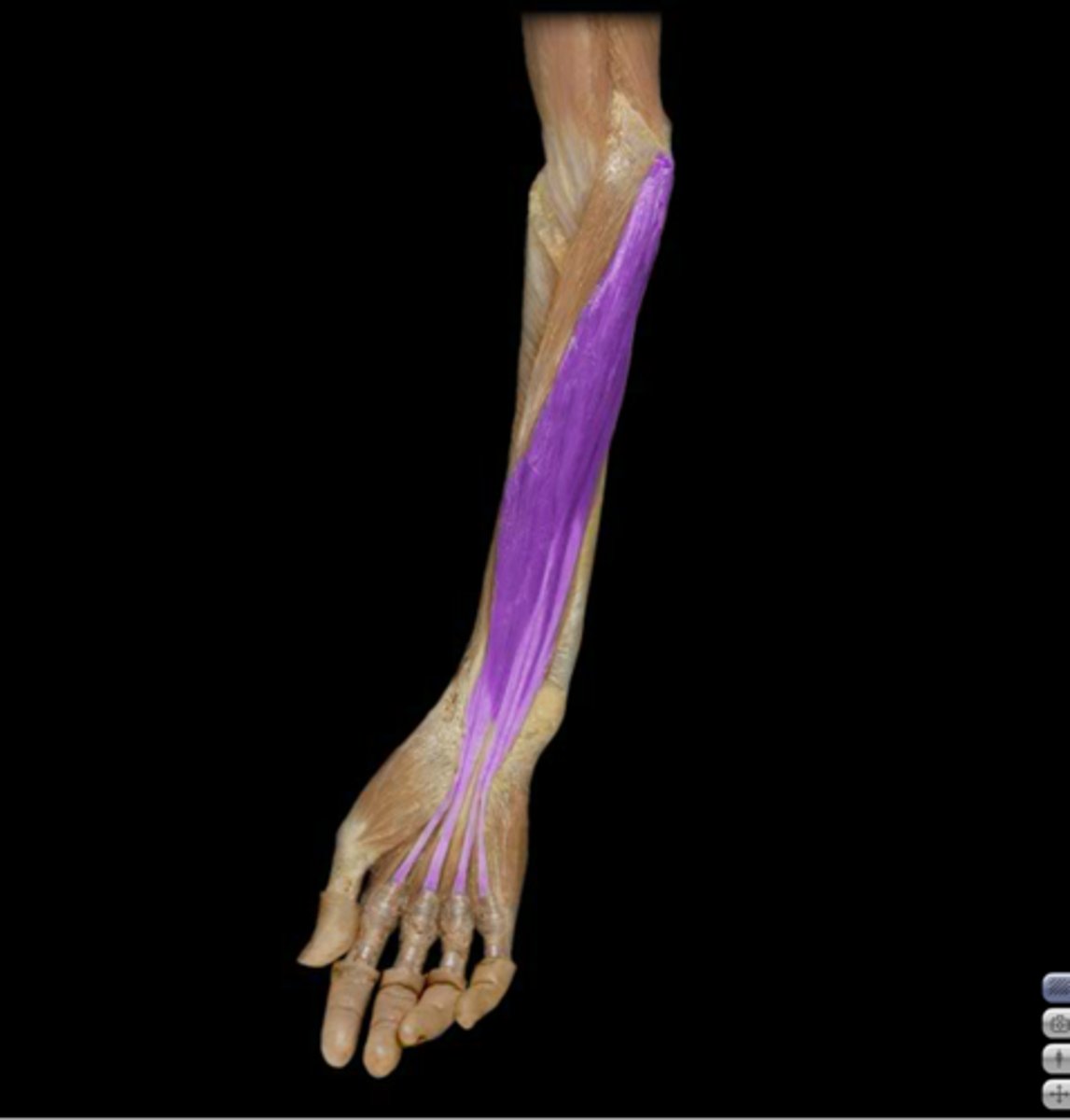 <p>Action: Digit 2-5 flexion at PIP joint</p><p>Origin:</p><p>- Humeroulnar head: medial epicondyle and</p><p>coronoid process of ulna</p><p>- Radial head: oblique line of radius</p><p>Insertion: Shaft of middle phalanges</p><p>Nerve innervation: Median nerve</p>