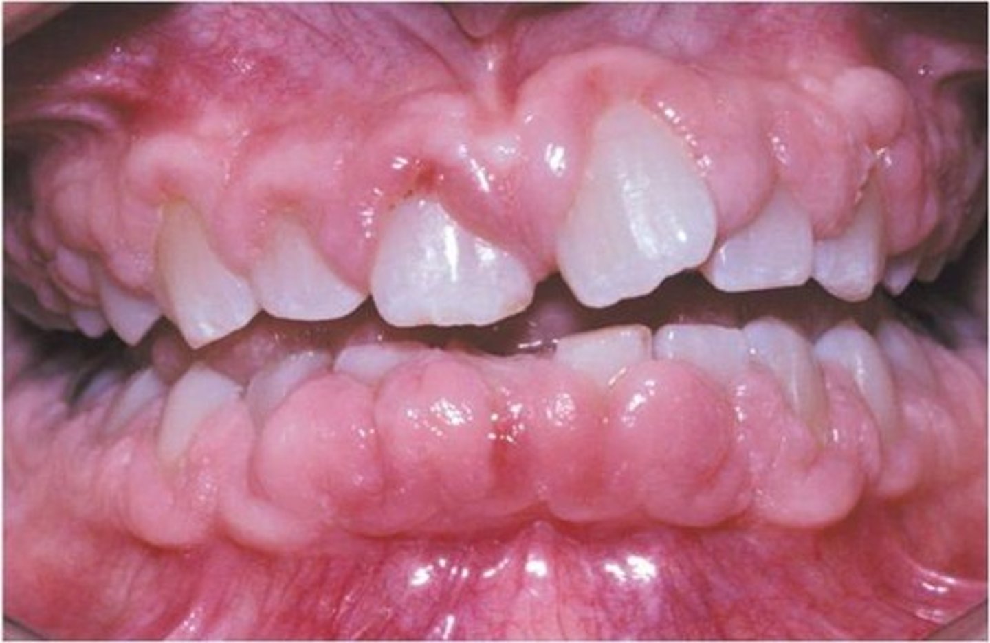 <p>increased size of marginal and attached gingiva </p><p>• local or generalized</p><p>• associated with drugs - Dilantin</p>