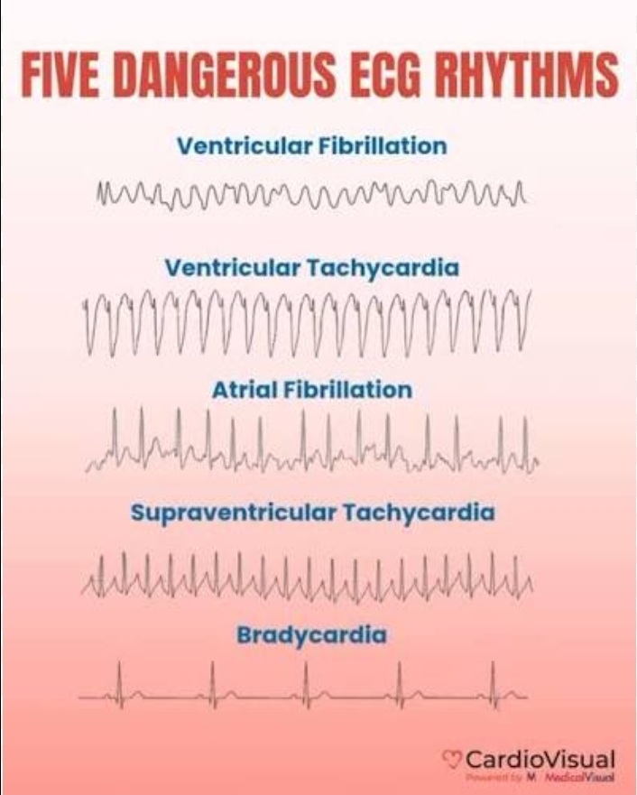 <p>Characterize the cardiac output in ventricular fibrillation.</p>