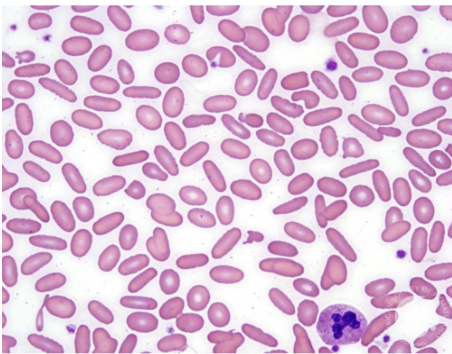 <p>what disease/condition is associated with elliptocytes?</p>