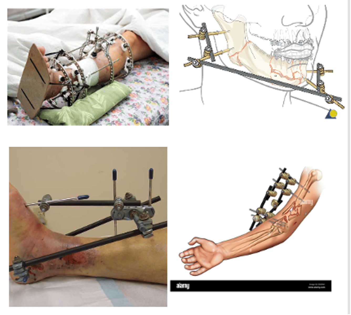 <p>External devices used to keep fractured bones stabilized and in alignment</p>