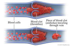 <p>Circular clot which is very dangerous, more worse than a thrombus(stationary clot)</p>