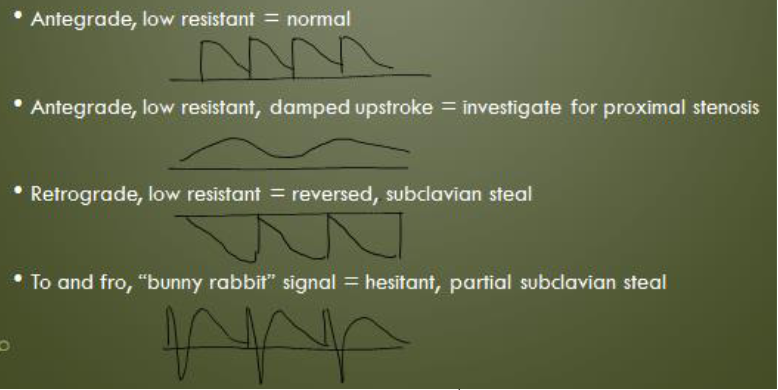 <p>What is subclavian steel, when does it occur</p>
