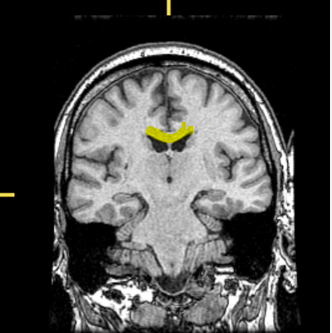 <p>What part of the brain is highlighted?</p>
