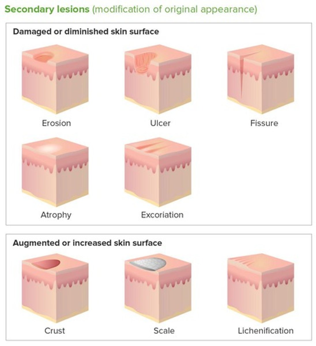 <p>Abrasion of outer layer due to scratching, rubbing, or trauma</p>