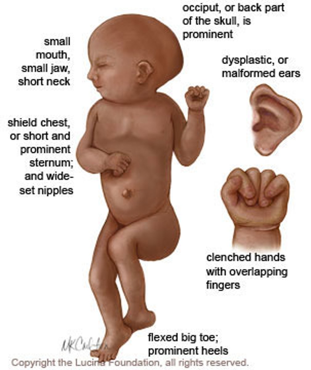 <p>trisomy 18 (edwards)</p><p>high infant mortality :(</p>