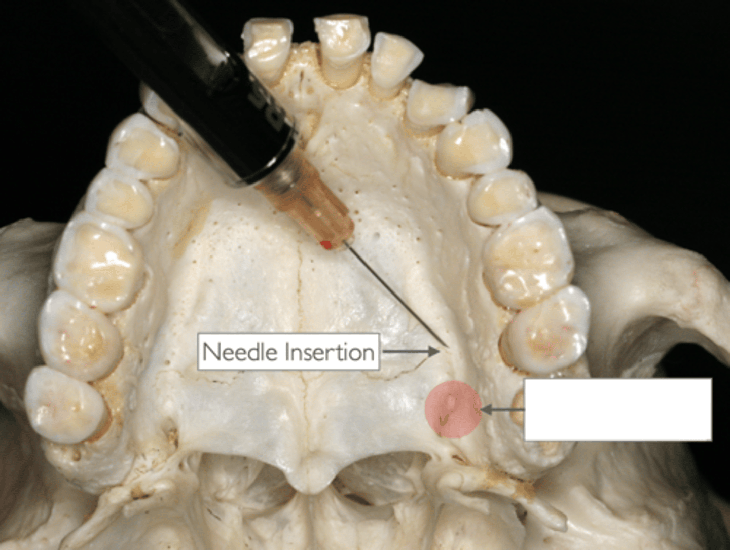 <p>What type of injection and what is the red circle indicating?</p>