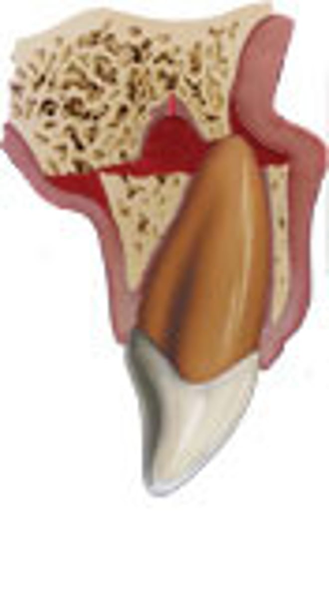 <p>alveolar bone</p><p>several teeth</p><p>occlusal interference</p>