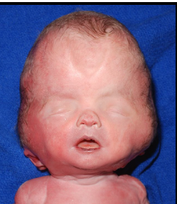 <p>enlarged anterior fontanelle, other cranial sutures fused, hydrocephalus, macrocephaly</p>