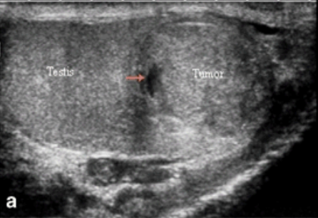 <p>Testicular CA</p>