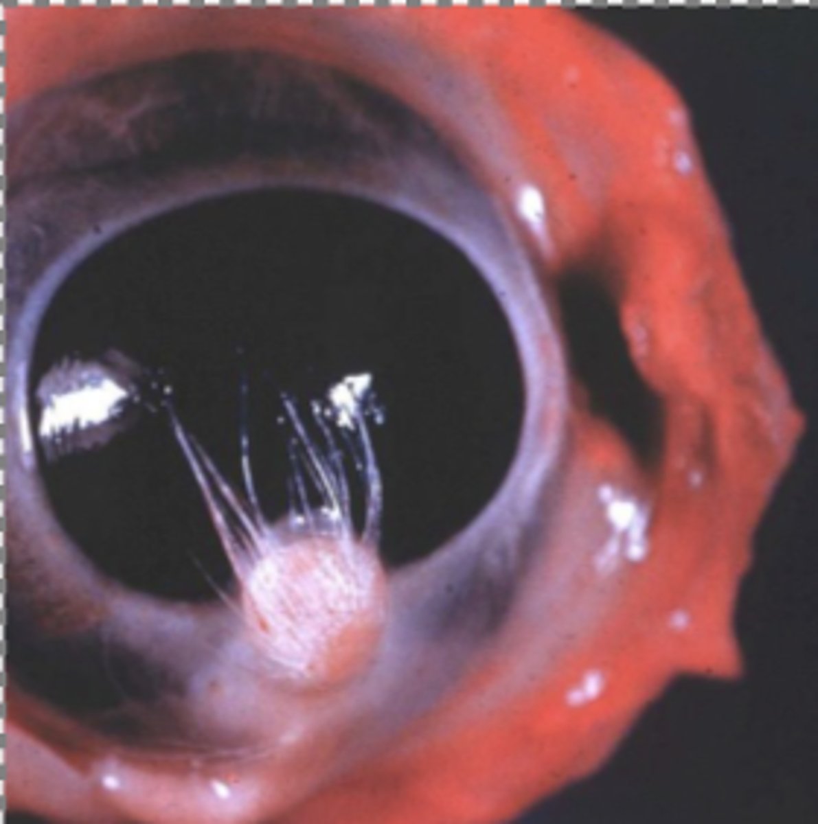 <p>What kind of tumor is this?</p>