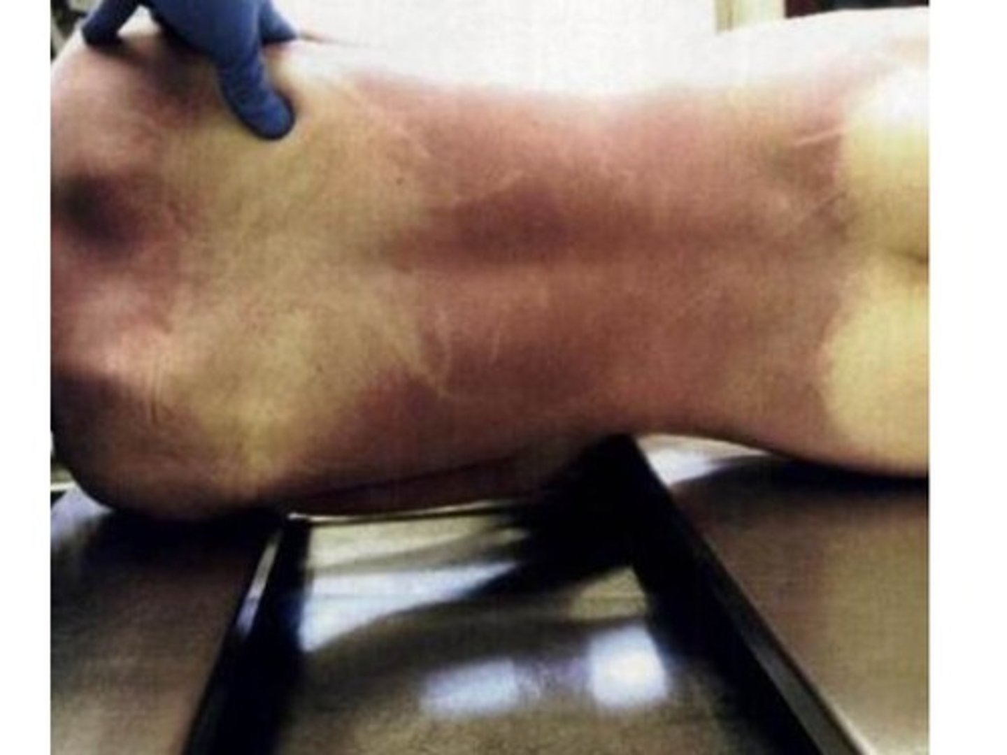<p>-is the "color of death"</p><p>-discoloration of the skin caused by the flow of blood into venous spaces under the influence of gravity</p><p>-onset is immediate</p><p>-sets in (blood starts settling) after 4 hours</p><p>-by 6-10 hours, has reached its max and is permanent</p>