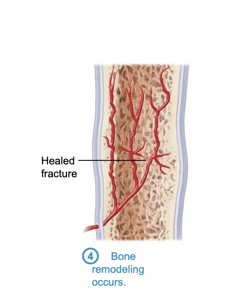<p>– Begins during bony callus formation and continues for several months</p><p>– Excess material on diaphysis exterior and within medullary cavity is removed</p><p>– Compact bone is laid down to reconstruct shaft walls</p><p>– Final structure resembles original structure</p><p> Responds to same mechanical stressors</p>