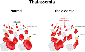 <p>What is Thalassemia?</p>