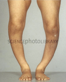 Vitamin d deficiency
