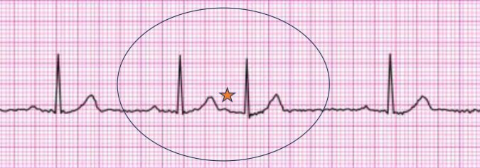 <p>early beat initiated w/in atria but not SA node</p><p>“ectopic”</p><p>rhythm: skipped/early beat may be felt by pt or on palpation</p><p>P wave present for every QRS complex, but different size/shape or buried in T wave from previous beat</p><p>PR interval normal</p><p>QRS narrow and normal</p><p>implications: usually benign; incr freq may lead to atrial fibrillation or SVT; may be caused by stress, nicotine, caffeine, alcohol, hypoxemia</p>
